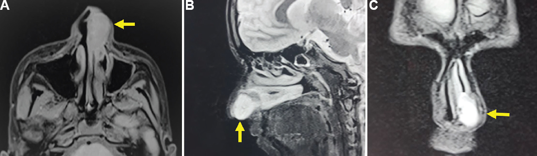 (A) Magnetic resonance imaging – a 24×11×21mm, isointense homogenous, well-defined mass in the left nasal cavity abutting the inferior turbinate posteriorly. (B) Magnetic resonance imaging – Nasal mass arising anteroinferior to septal cartilage. (C) Magnetic resonance imaging – Hyperintense nasal mass confined to the vestibule of the left nasal cavity.